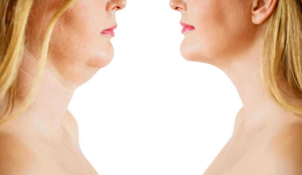 Double Chin treatment Cheadle before and after results
