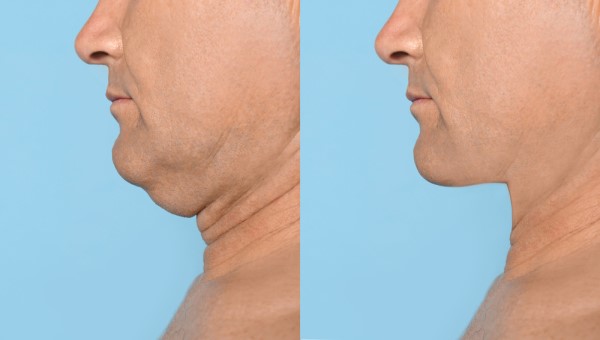 Which Non-Surgical Treatments Work Best for Jowls and Loose Skin Cheadle?