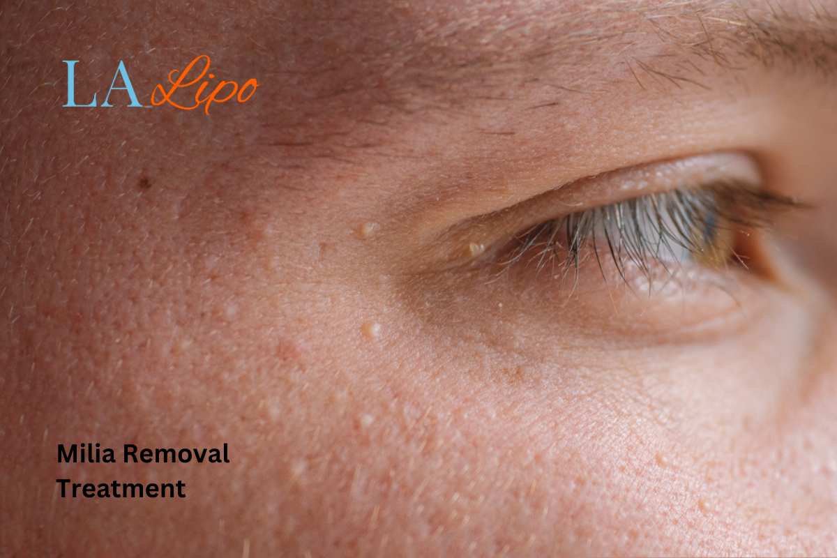 Cryopen Milia Removal: Is It the Easiest and Safest Option Cheadle?
