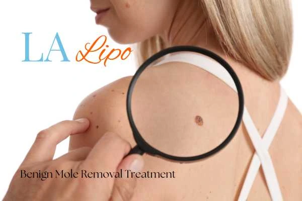 Why getting moles removed Cheadle can boost your confidence!
