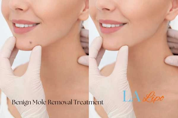 woman's before and after mole removal Cheadle results