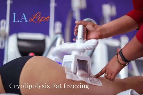 women getting fat freezing Cheadle