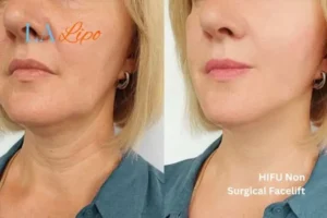 hi-fu for wrinkles Cheadle before and after results