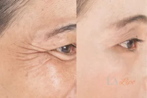 Before and after results of woman - HI-fu wrinkles reduction treatment Cheadle