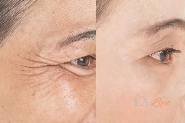 Before and after results of woman - HI-fu wrinkles reduction treatment Cheadle