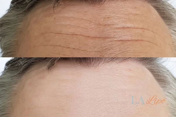 results of HIFU Cheadle on mans forehead to help reduce lines and wrinkles