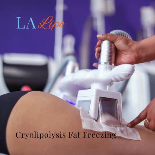 fat freezing - Cryolipolysis Cheadle
