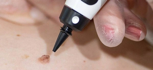 skin tag removal using cryopen Cheadle
