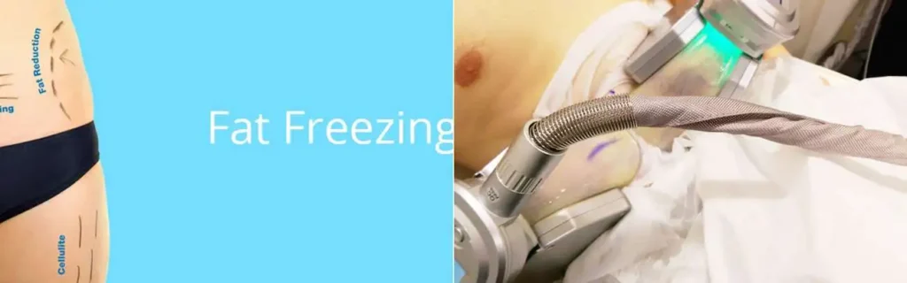 multi areas of a persons body having coolsculpting Cheadle treatment