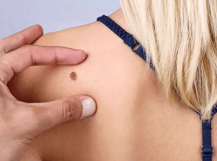 woman having mole removal Cheadle consultation before treatment.
