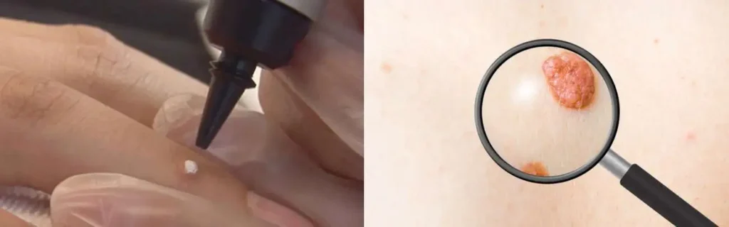 Cryopen for mole removal Cheadle - speak to our team today!