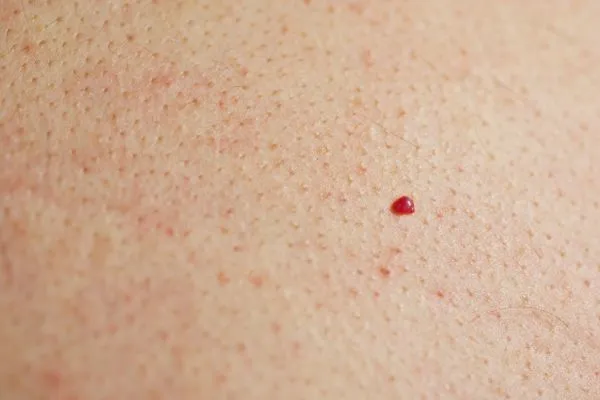 close up of a cherry angioma Cheadle