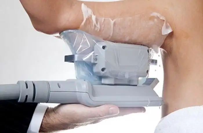 Picture of fat freezing Cheadle on the upper arms.