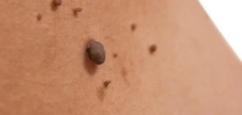 image of a skin tag Cheadle