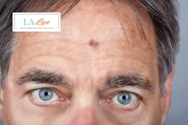 Solar Lentigo Removal Cheadle image of man with mark on his forehead