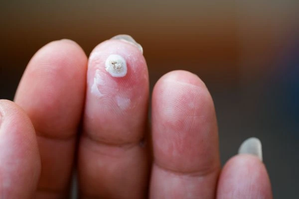wart on person finger - cryotherapy to treat from LA LIPO Cheadle