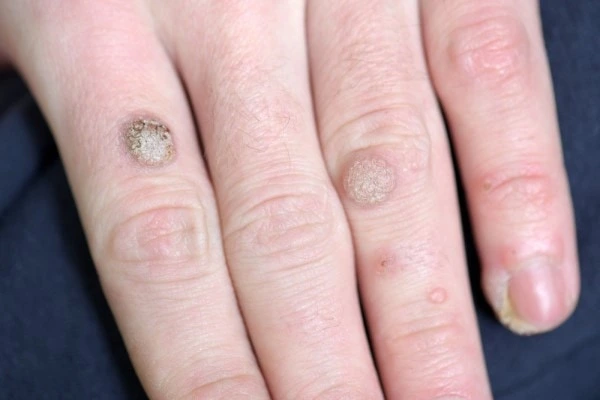 photo of warts on person hand - see wart removal Cheadle from LA LIPO