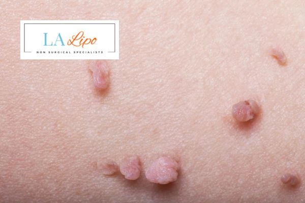 Does cryopen skin tag removal Cheadle hurt? Find out now call our team today!