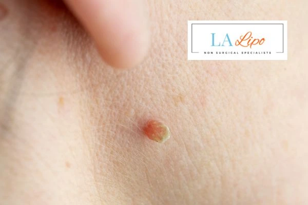 Book skin tag removal Cheadle today speak to our team now!