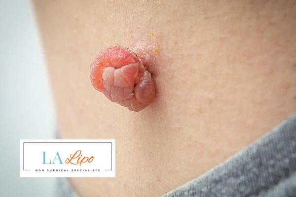 Interested in skin tag removal Cheadle? Concerned about the pain? Find out more today!