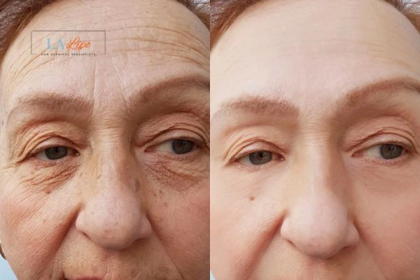 The powerful benefits of Morpheus8 Treatment Cheadle - Call Our team today!