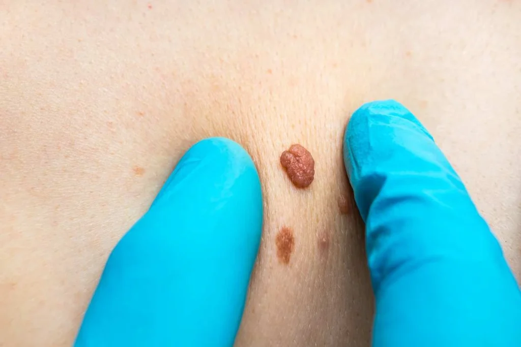LA LIPO Cryopen Lesion Removal Prices Cheadle