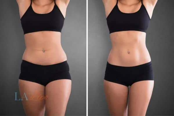 before and after results of non-surgical treatment to help a woman's body image and mental health Cheadle