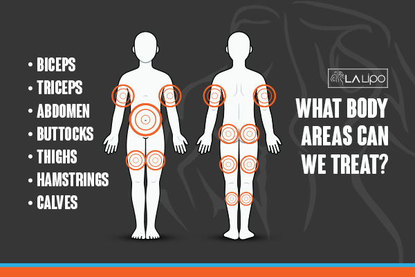 Diagram to show areas you can have LA-EMS Body Sculpting Treatment Cheadle