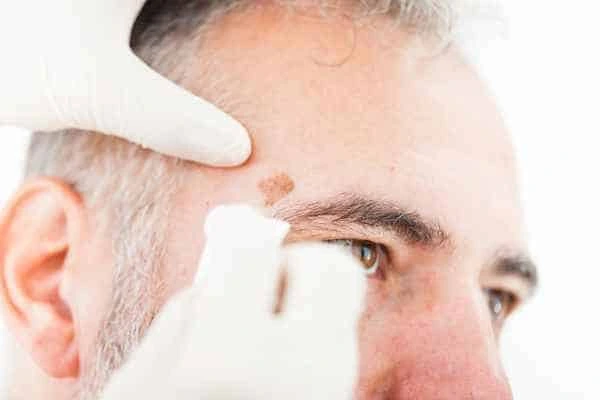 Age spots and elderly people Cheadle what is the link?