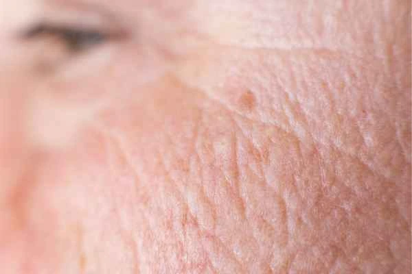 close up picture of a woman's face showing an age spot Cheadle