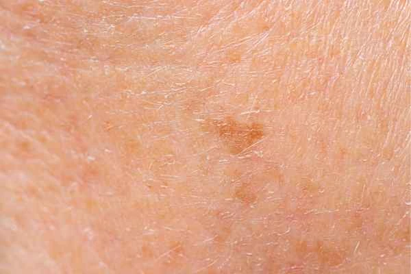 close up picture of age spots Cheadle