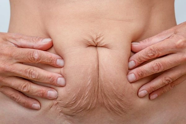 Image of a woman's stomach with loose skin - example of skin tightening Cheadle options