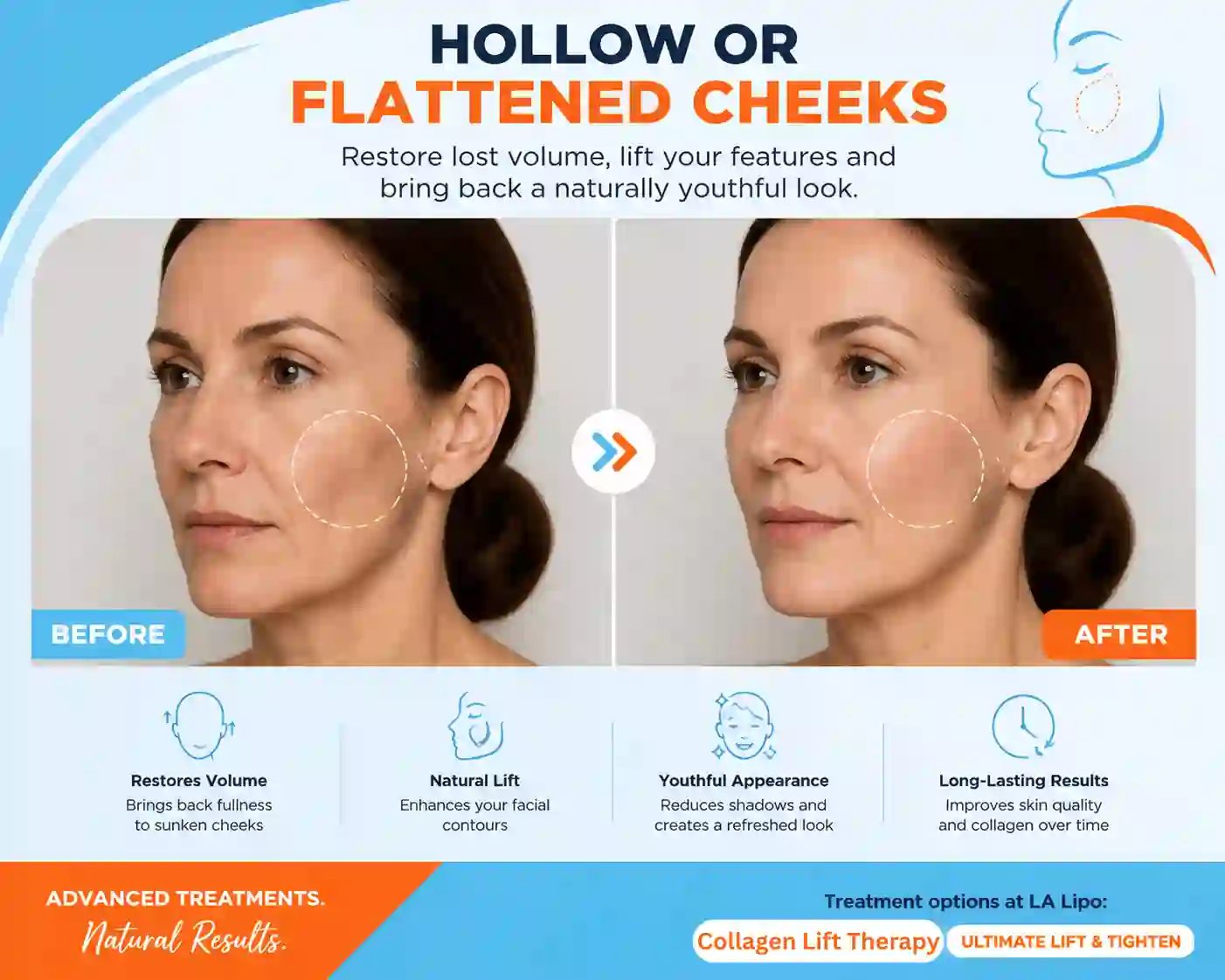 Sign #4: Hollow or Flattened Cheeks Cheadle